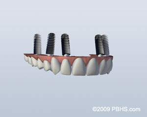 implant retained denters