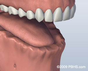 before implant retained dentures