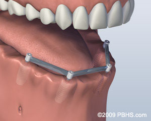 implant dentures process