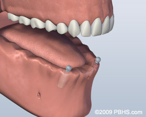 implant dentures