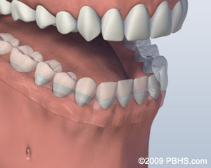 implant dentures