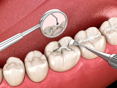 dental fillings