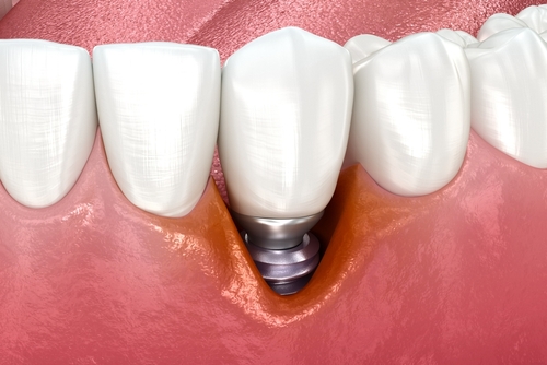 dental implants