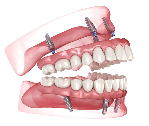 implant dentures