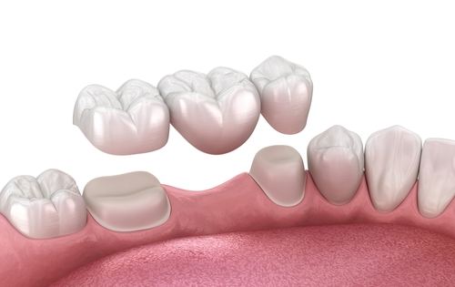 dental bridges