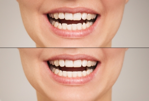 before and after Invisalign treatment