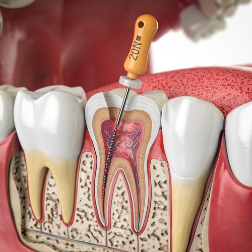 root canal treatment