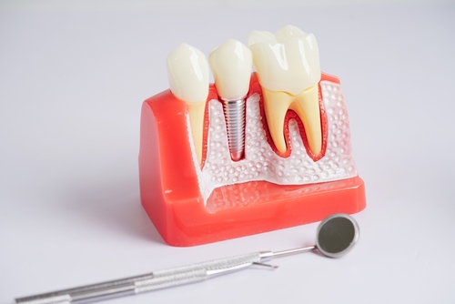 dental implants